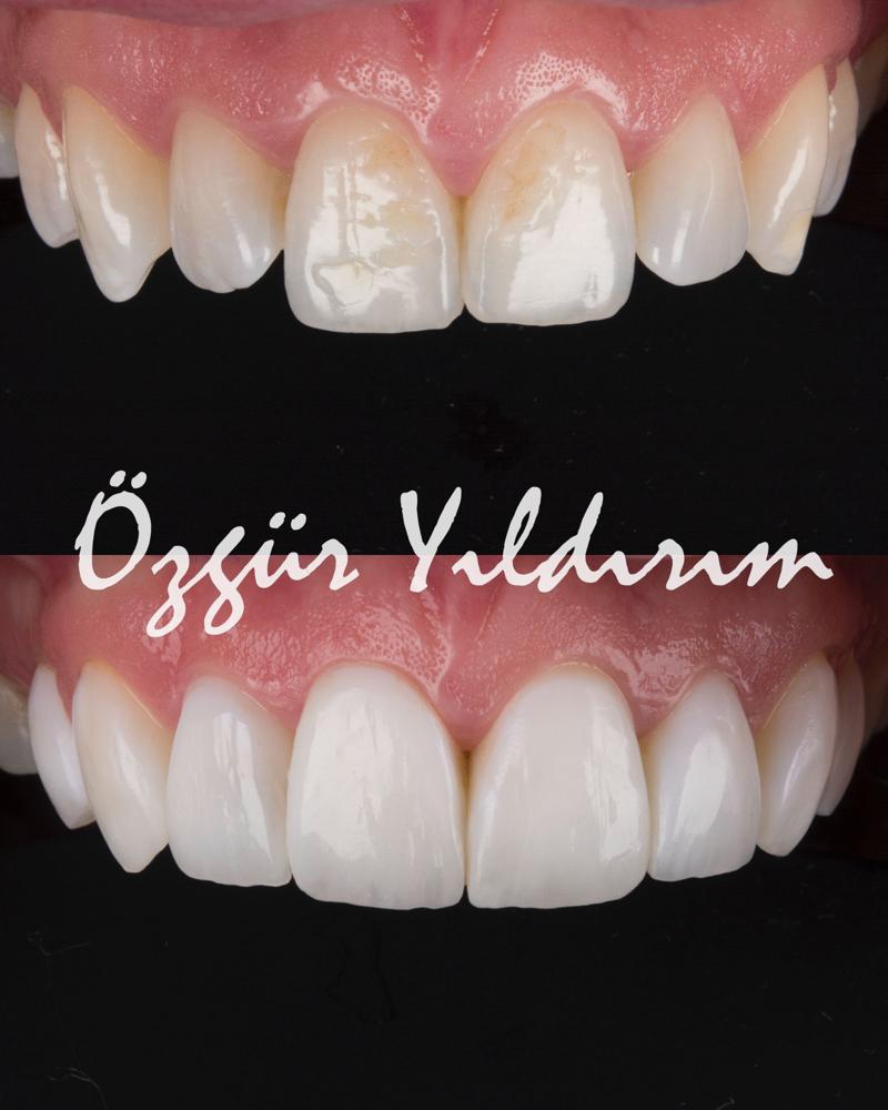 Галерея улыбок | Dentist Özgür Yıldırım